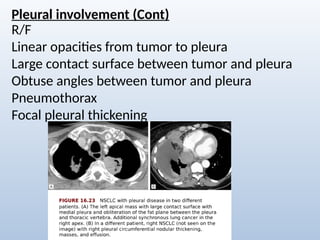 Comprehensive Radiological Overview of Lung Tumors and Thoracic ...
