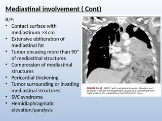 Comprehensive Radiological Overview of Lung Tumors and Thoracic ...