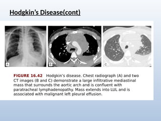 Comprehensive Radiological Overview of Lung Tumors and Thoracic ...