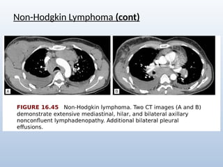 Comprehensive Radiological Overview of Lung Tumors and Thoracic ...