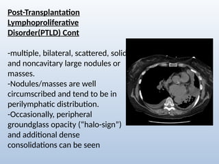 Comprehensive Radiological Overview of Lung Tumors and Thoracic ...