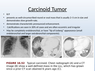Comprehensive Radiological Overview of Lung Tumors and Thoracic ...