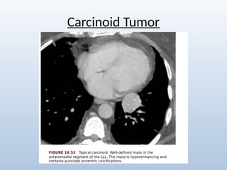 Comprehensive Radiological Overview of Lung Tumors and Thoracic ...