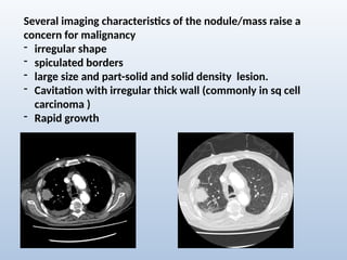 Comprehensive Radiological Overview of Lung Tumors and Thoracic ...