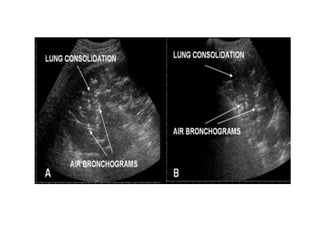Lung Ultrasound | PDF