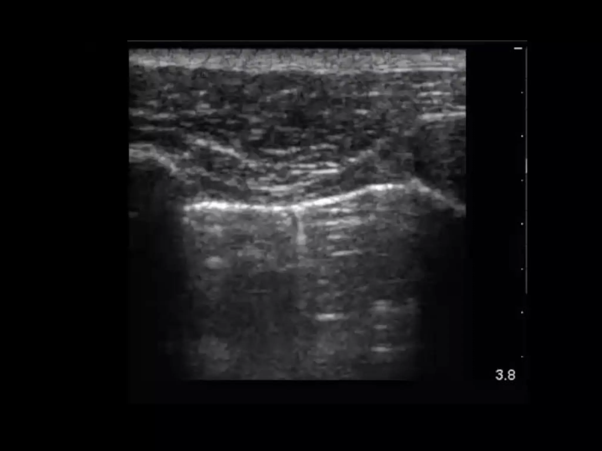Lung ultrasound
