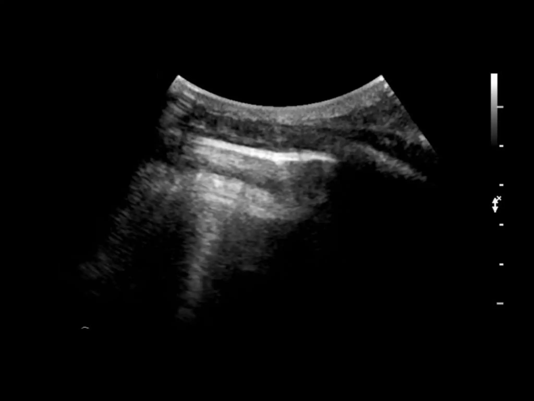 Lung ultrasound