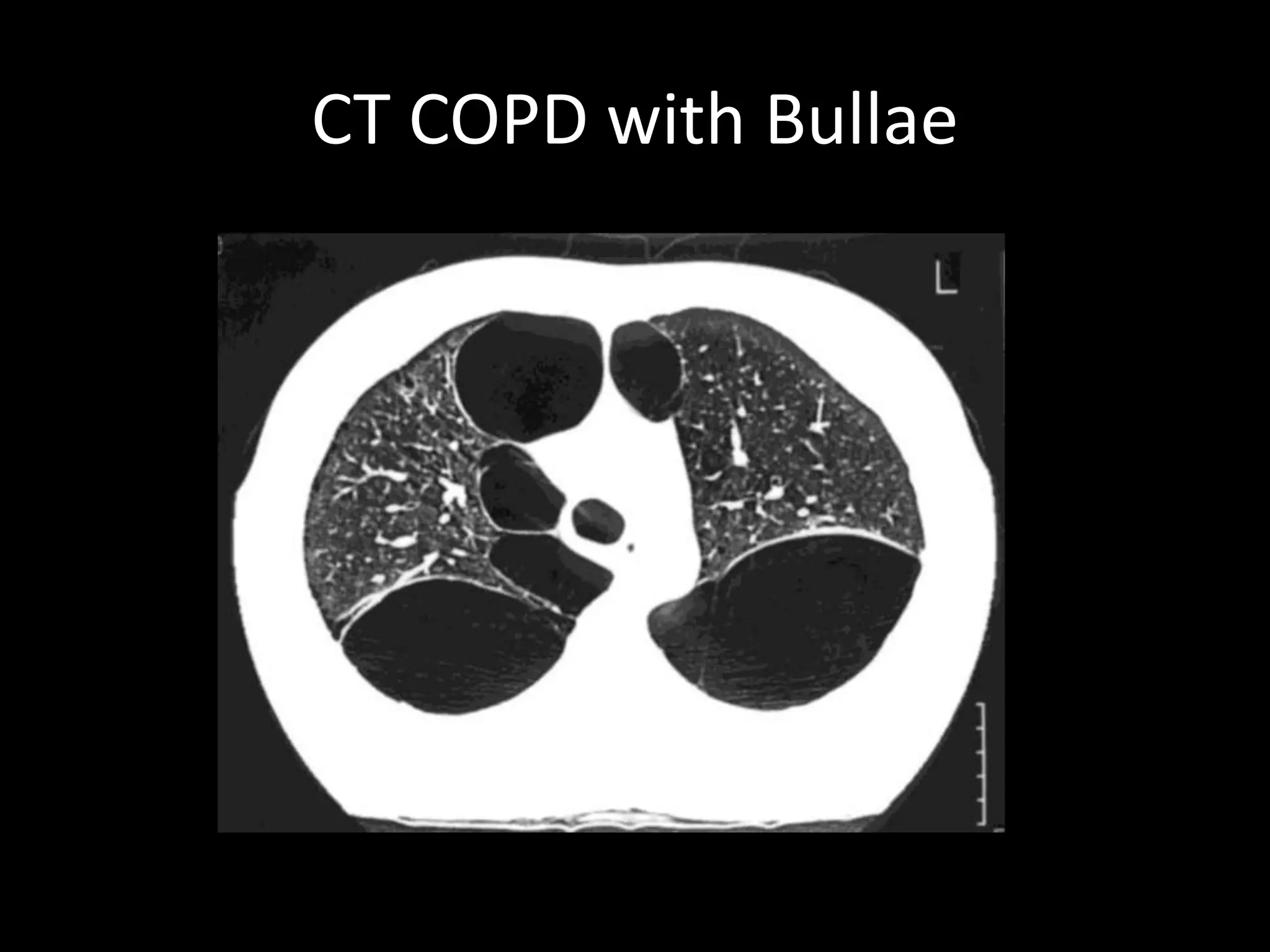 CT COPD with Bullae
 