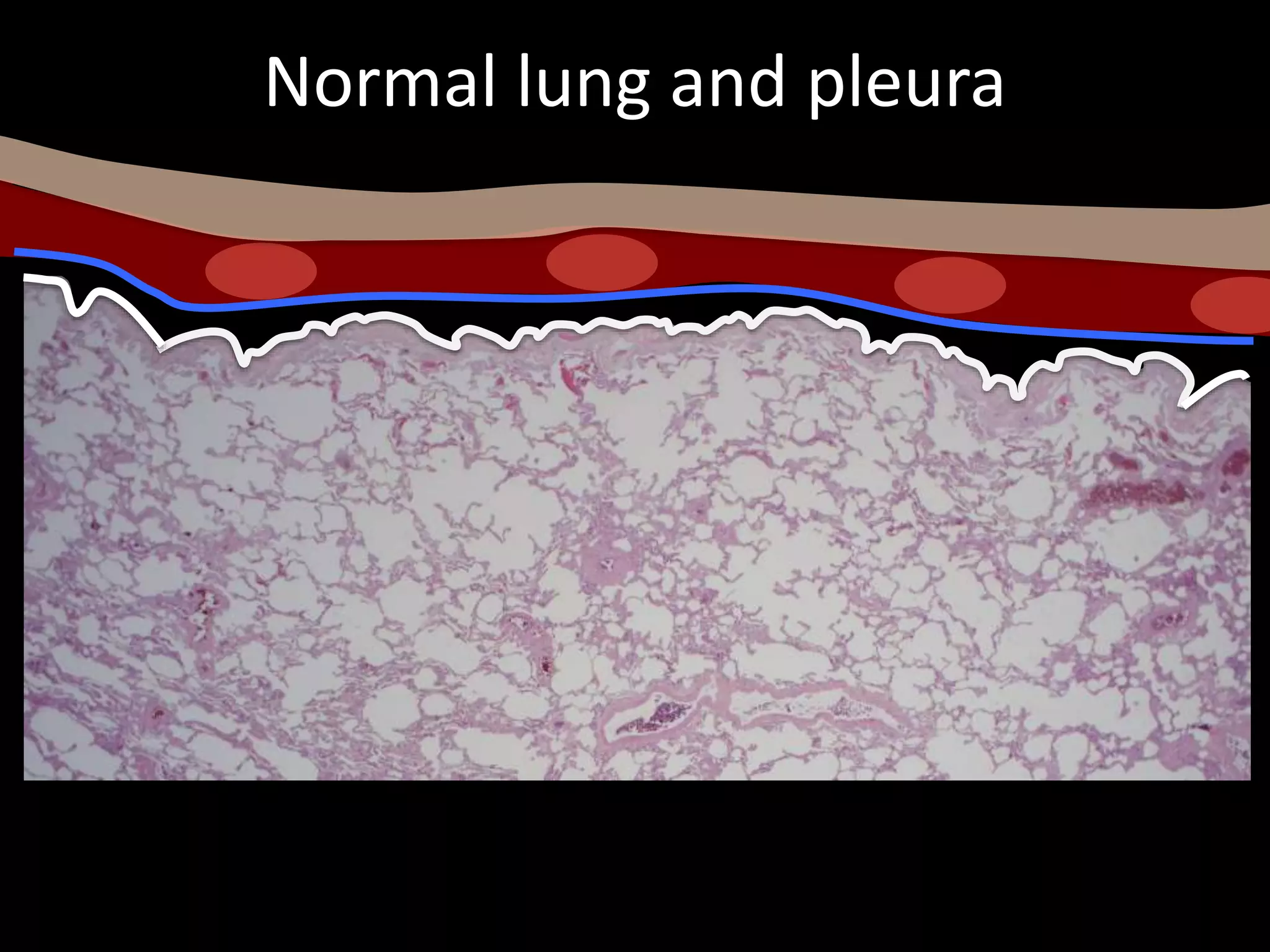 Normal lung and pleura
 