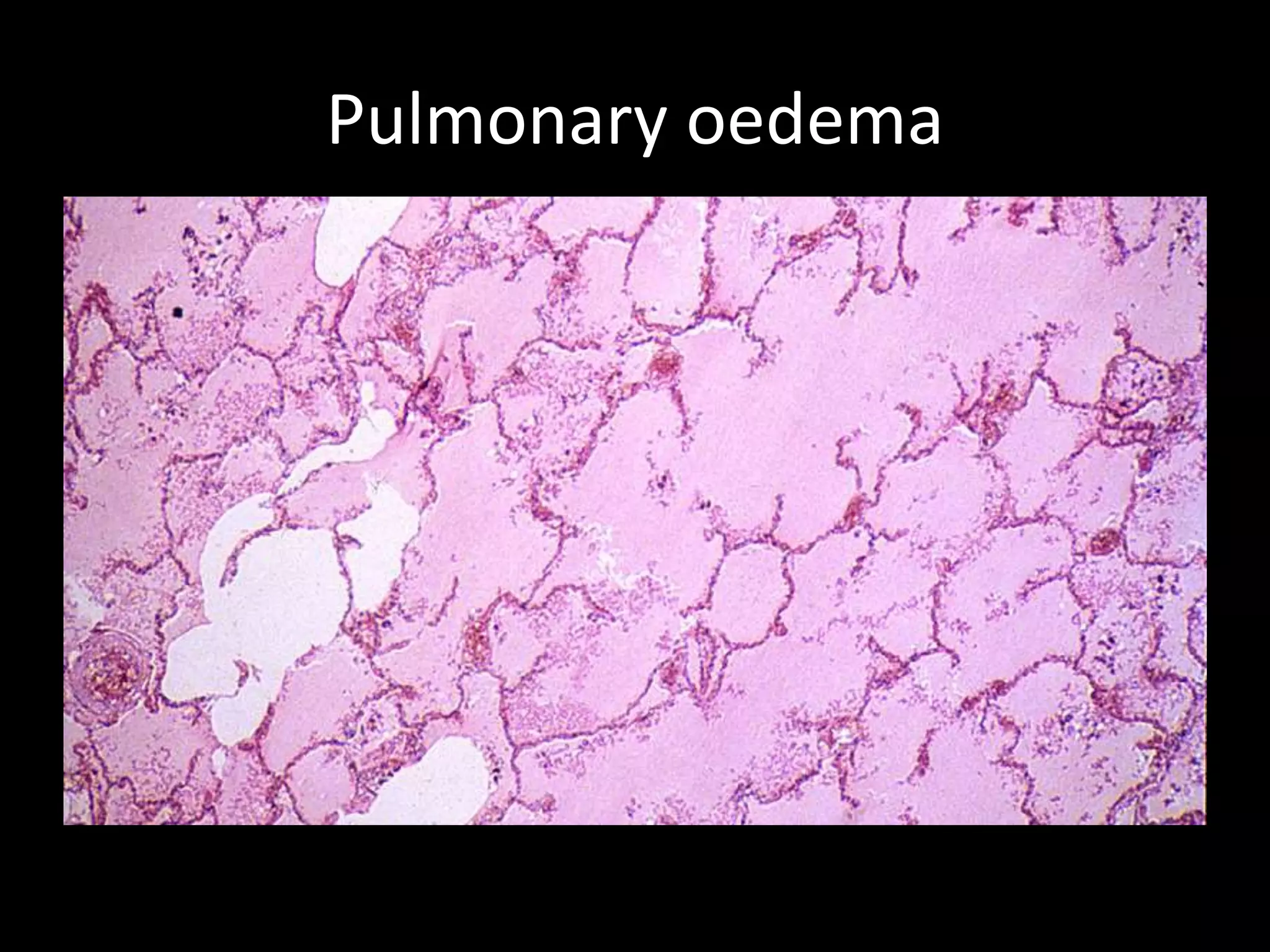 Pulmonary oedema
 