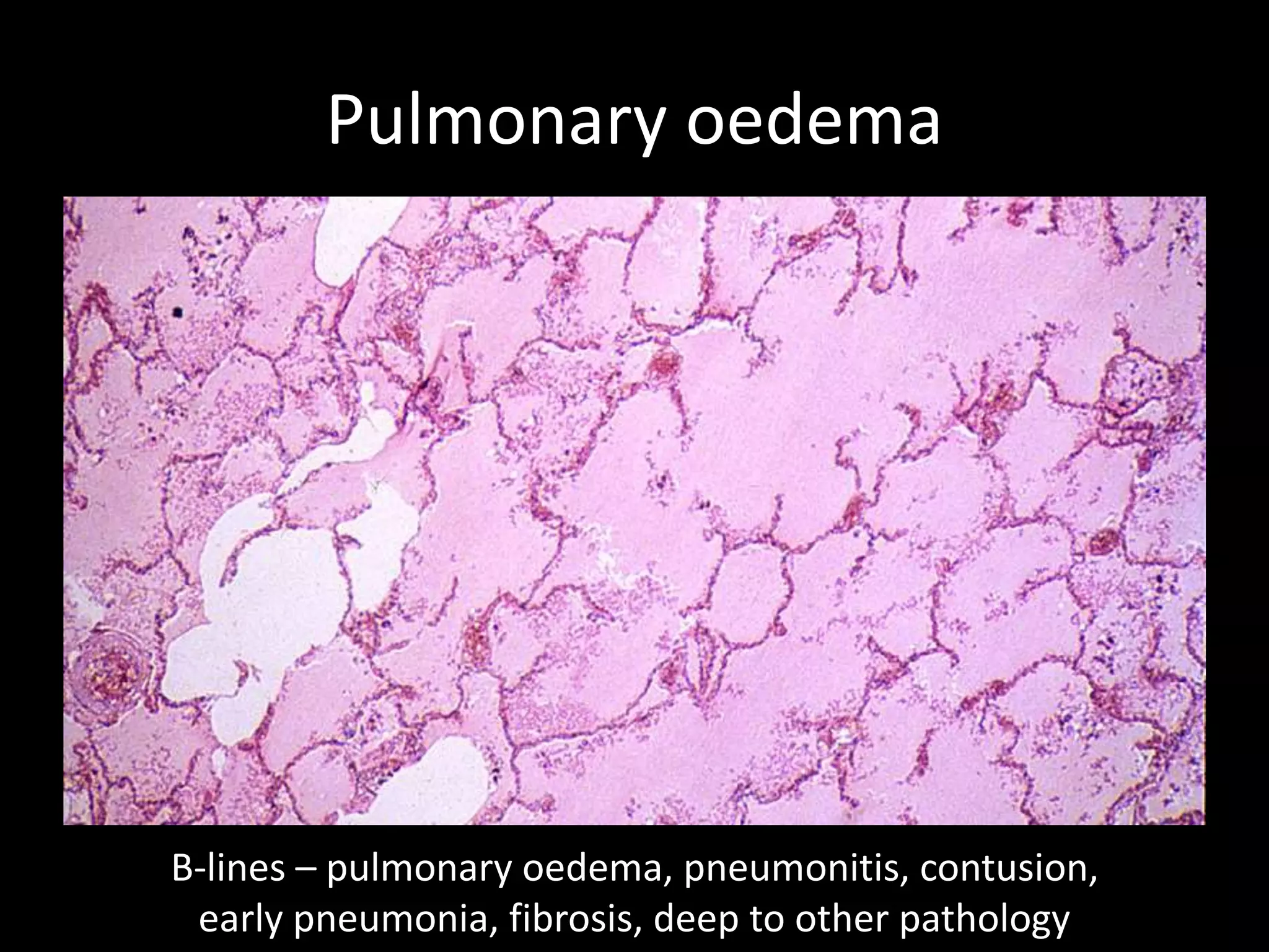 Pulmonary oedema
B-lines – pulmonary oedema, pneumonitis, contusion,
early pneumonia, fibrosis, deep to other pathology
 