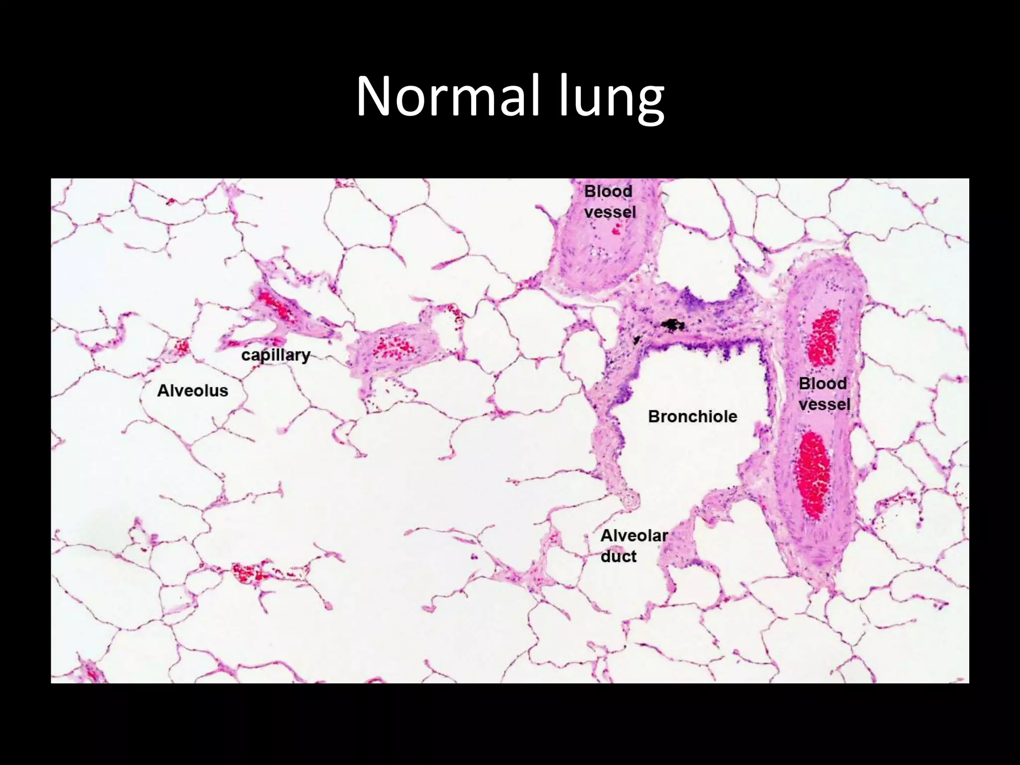 Normal lung
 