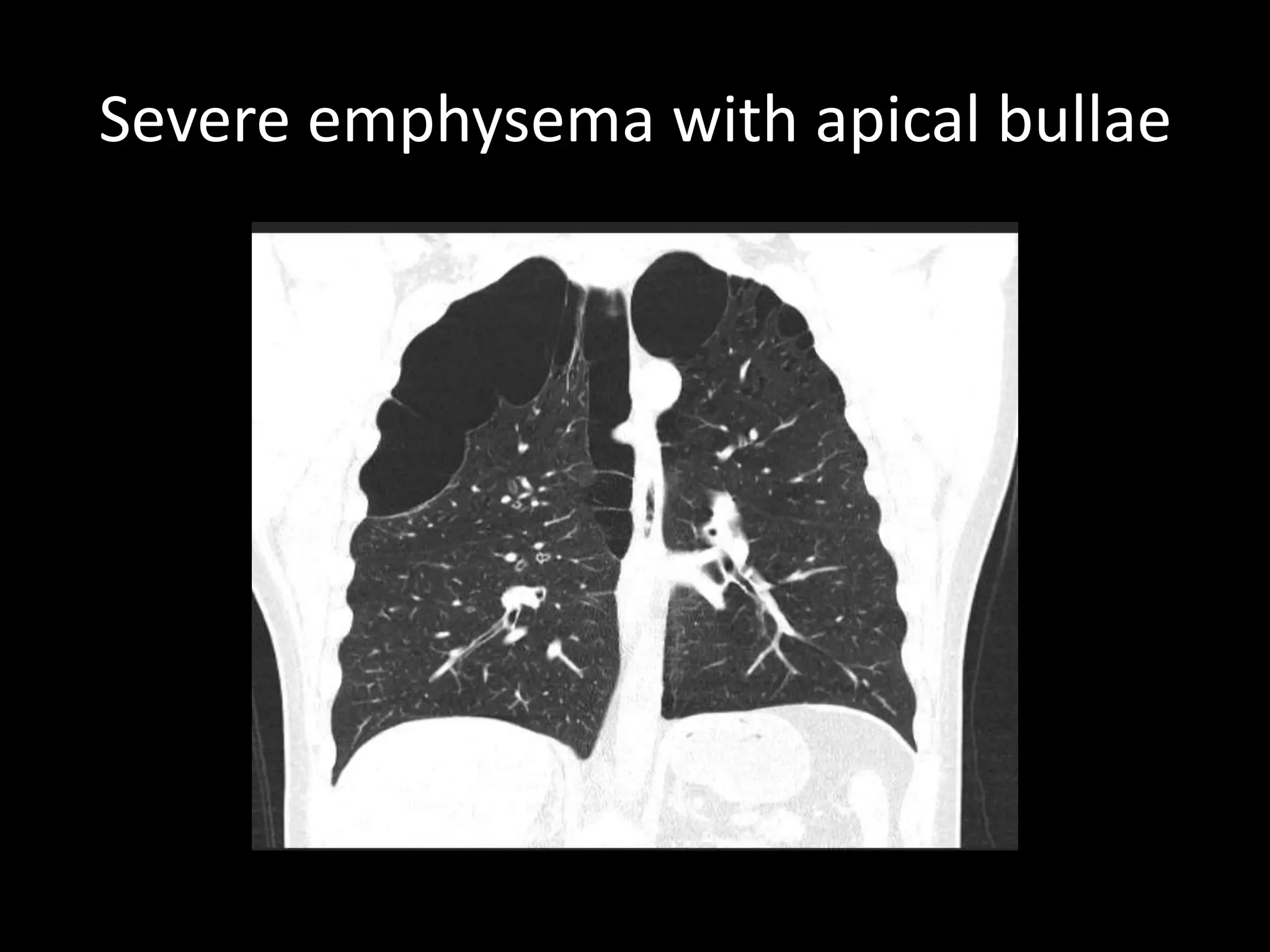 Severe emphysema with apical bullae
 