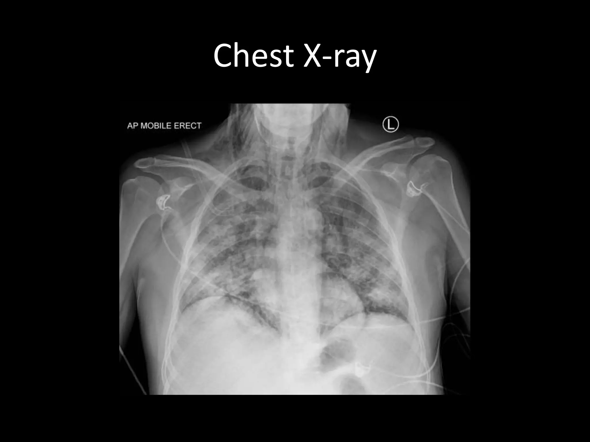 Chest X-ray
 