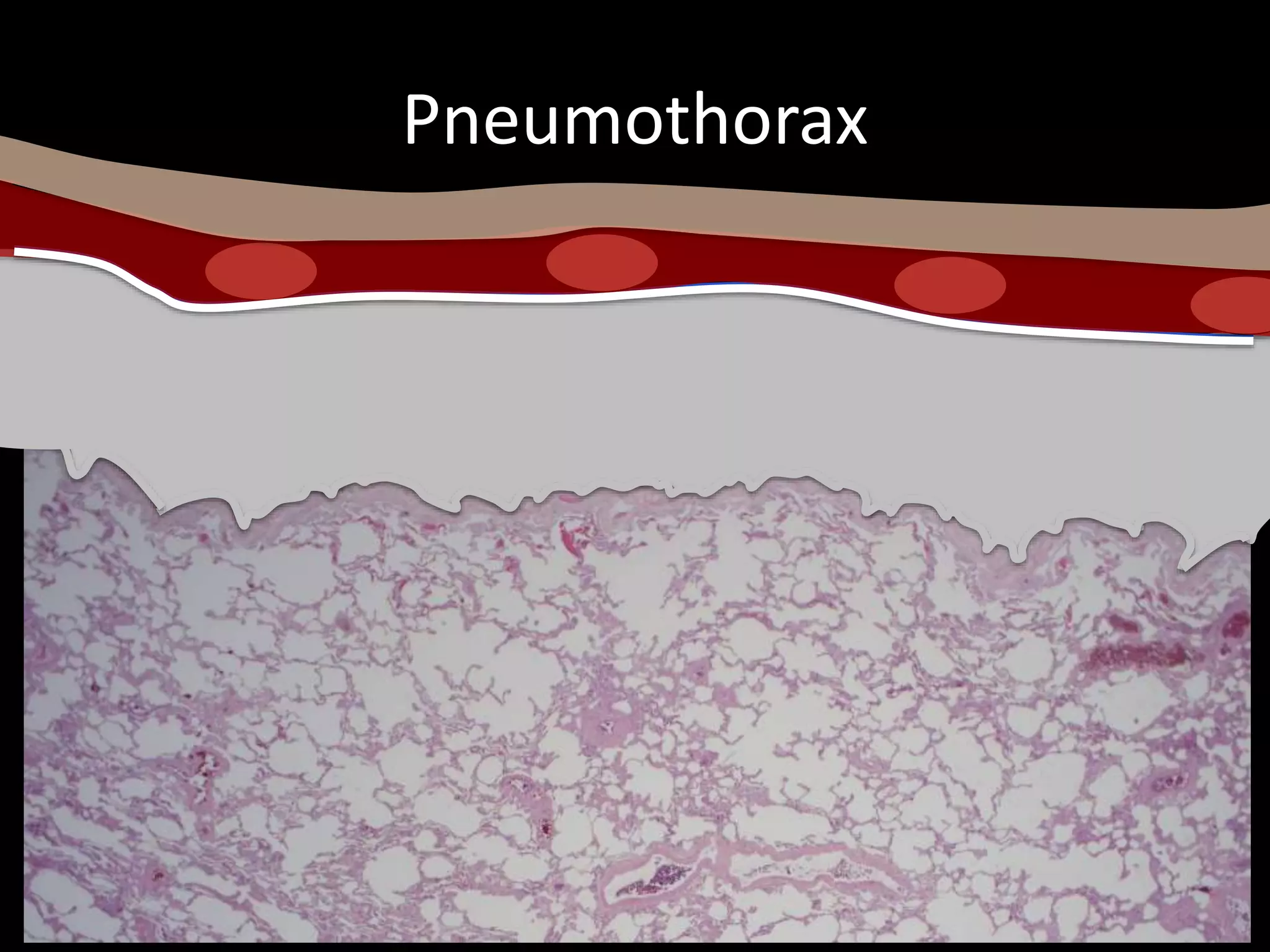 Pneumothorax
 