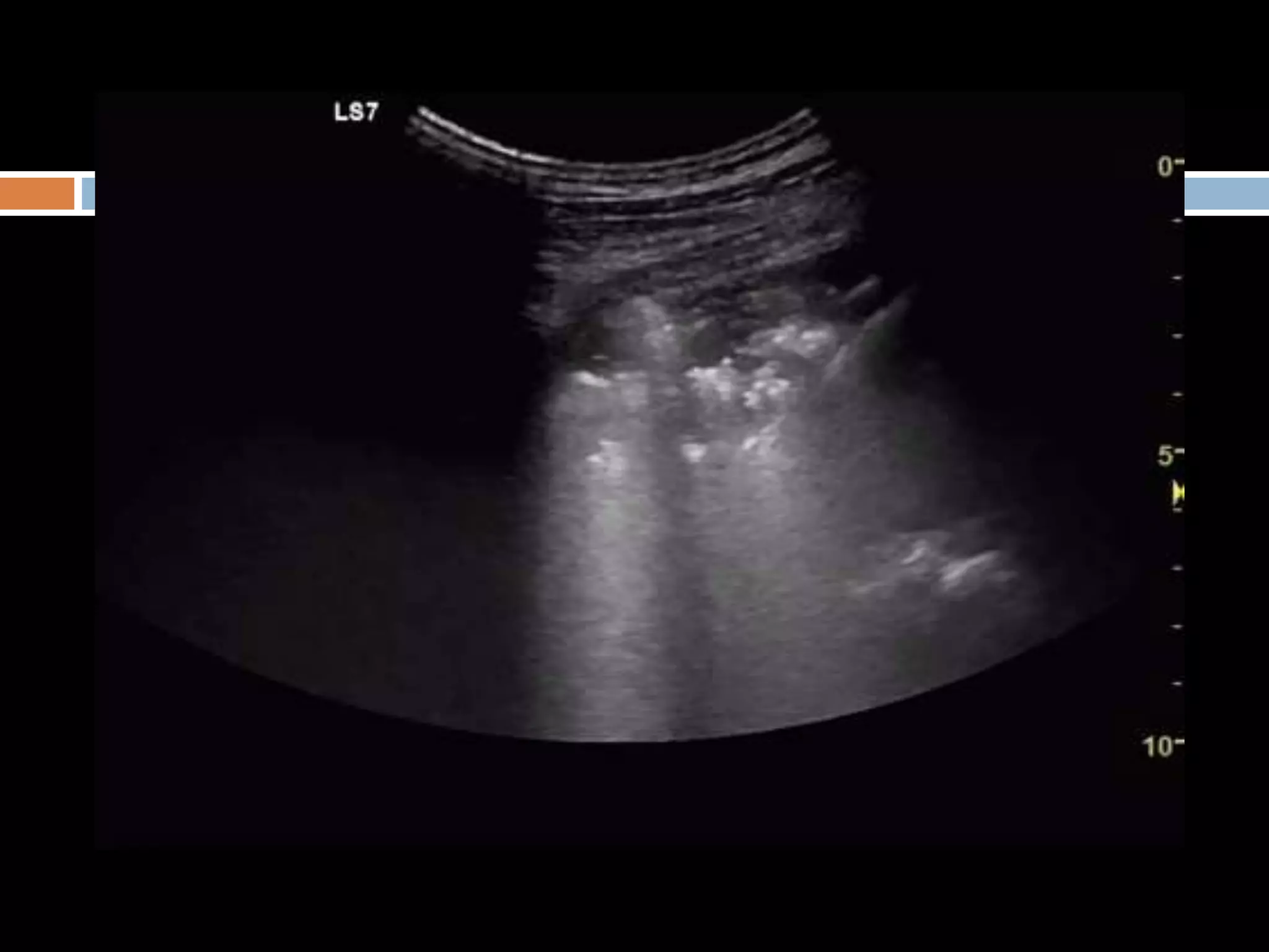 Lung ultrasound for diagnosis of pneumonia | PPTX