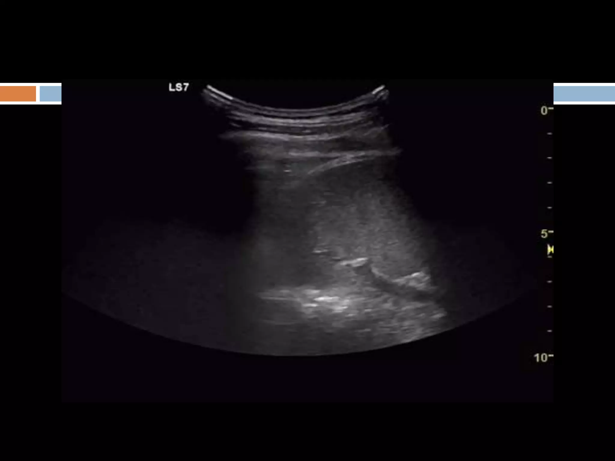 Lung ultrasound for diagnosis of pneumonia | PPTX