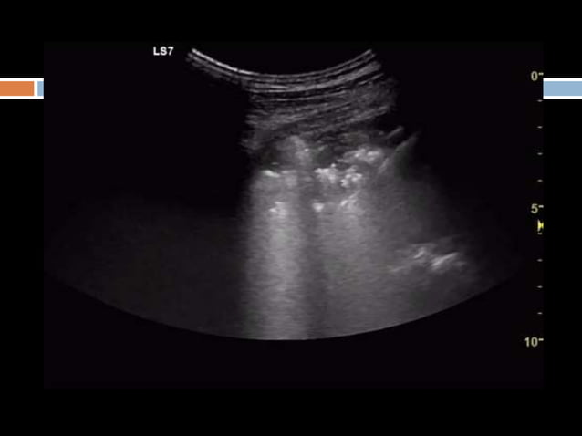 Lung ultrasound for diagnosis of pneumonia | PPTX | Lung and ...