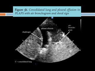 Lung ultrasound for diagnosis of pneumonia | PPTX