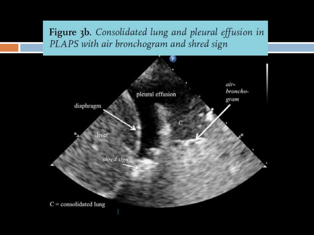 Lung ultrasound for diagnosis of pneumonia | PPTX | Lung and ...