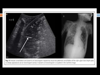 Lung ultrasound for diagnosis of pneumonia | PPTX