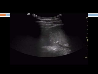 Lung ultrasound for diagnosis of pneumonia | PPTX