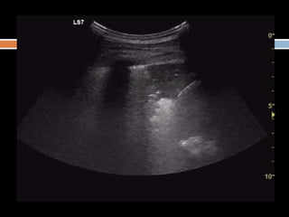 Lung ultrasound for diagnosis of pneumonia | PPTX