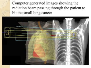Computer generated images showing the
radiation beam passing through the patient to
hit the small lung cancer
 