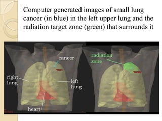 Computer generated images of small lung
cancer (in blue) in the left upper lung and the
radiation target zone (green) that surrounds it
 