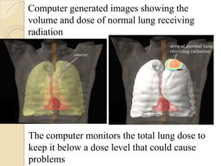 Computer generated images showing the
volume and dose of normal lung receiving
radiation




The computer monitors the total lung dose to
keep it below a dose level that could cause
problems
 