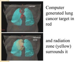 Computer
generated lung
cancer target in
red


and radiation
zone (yellow)
surrounds it
 