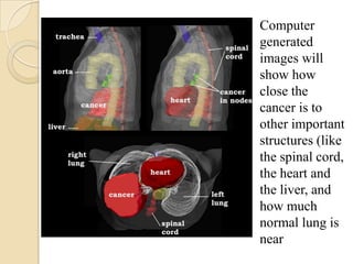 Computer
generated
images will
show how
close the
cancer is to
other important
structures (like
the spinal cord,
the heart and
the liver, and
how much
normal lung is
near
 