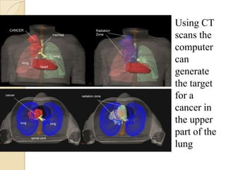 Using CT
scans the
computer
can
generate
the target
for a
cancer in
the upper
part of the
lung
 