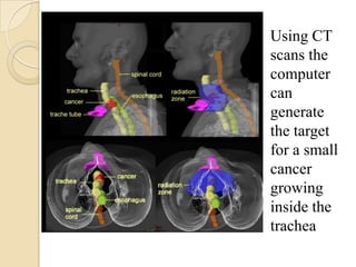 Using CT
scans the
computer
can
generate
the target
for a small
cancer
growing
inside the
trachea
 