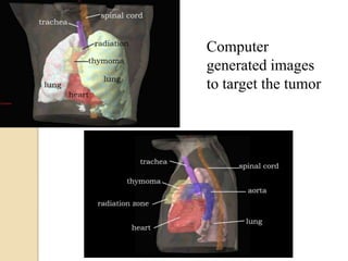 Computer
generated images
to target the tumor
 