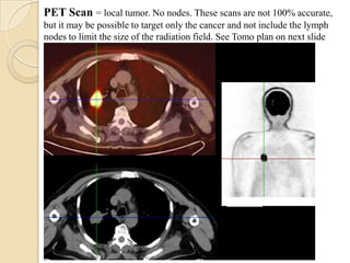 PET Scan = local tumor. No nodes. These scans are not 100% accurate,
but it may be possible to target only the cancer and not include the lymph
nodes to limit the size of the radiation field. See Tomo plan on next slide
 