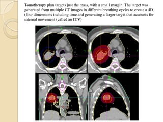 Tomotherapy plan targets just the mass, with a small margin. The target was
generated from multiple CT images in different breathing cycles to create a 4D
(four dimensions including time and generating a larger target that accounts for
internal movement (called an ITV)
 