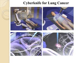 Cyberknife for Lung Cancer
 
