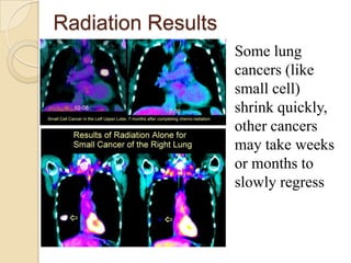 Radiation Results
                    Some lung
                    cancers (like
                    small cell)
                    shrink quickly,
                    other cancers
                    may take weeks
                    or months to
                    slowly regress
 