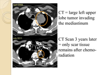 CT = large left upper
lobe tumor invading
the mediastinum


CT Scan 3 years later
= only scar tissue
remains after chemo-
radiation
 
