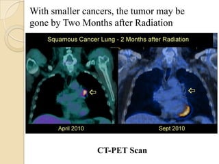 With smaller cancers, the tumor may be
gone by Two Months after Radiation




                CT-PET Scan
 