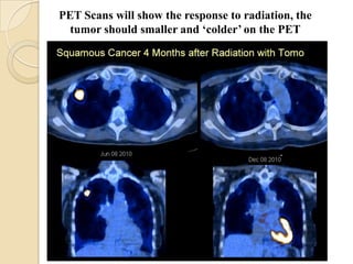 PET Scans will show the response to radiation, the
  tumor should smaller and ‘colder’ on the PET
 
