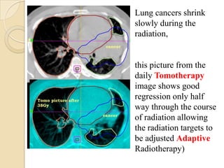 Lung cancers shrink
slowly during the
radiation,


this picture from the
daily Tomotherapy
image shows good
regression only half
way through the course
of radiation allowing
the radiation targets to
be adjusted Adaptive
Radiotherapy)
 