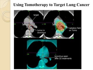 Using Tomotherapy to Target Lung Cancer
 