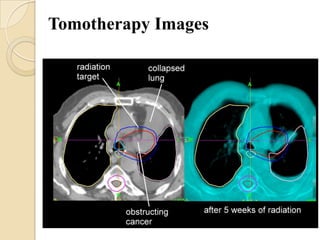Tomotherapy Images
 