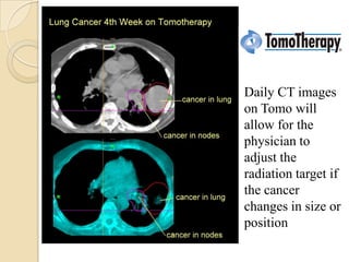 Daily CT images
on Tomo will
allow for the
physician to
adjust the
radiation target if
the cancer
changes in size or
position
 