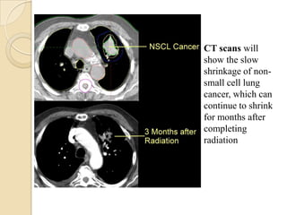 CT scans will
show the slow
shrinkage of non-
small cell lung
cancer, which can
continue to shrink
for months after
completing
radiation
 