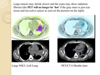Large tumors may shrink slower and the scans may show radiation
 fibrosis (the PET will no longer be ‘hot’ if the gray mass is just scar
 tissue and not active cancer as seen on the pictures on the right)




Large NSCL Left Lung                         PET/CT 6 Months later
 