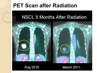 PET Scan after Radiation
 