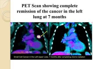 PET Scan showing complete
remission of the cancer in the left
        lung at 7 months
 